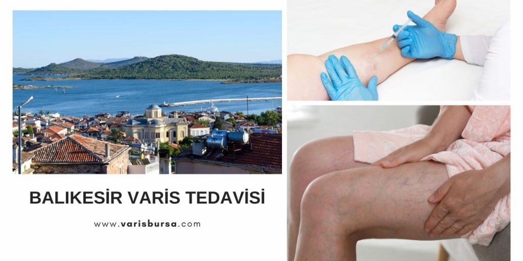 Balıkesir Varis Tedavisi