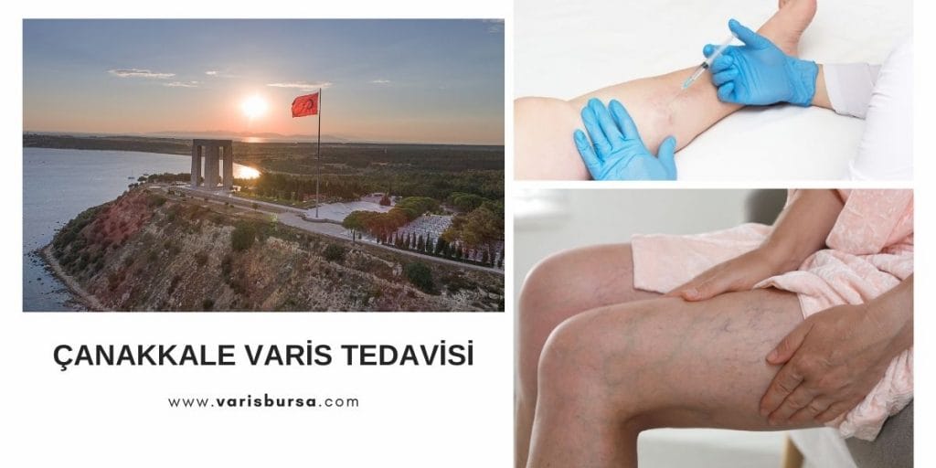 Çanakkale Varis Tedavisi