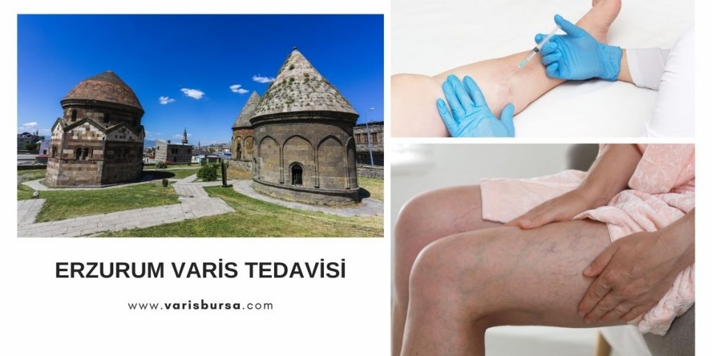 Erzurum Varis Tedavisi