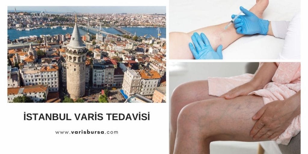 İstanbul Varis Tedavisi