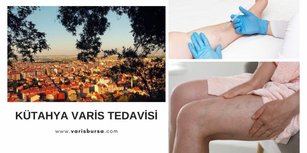 Kütahya Varis Tedavisi
