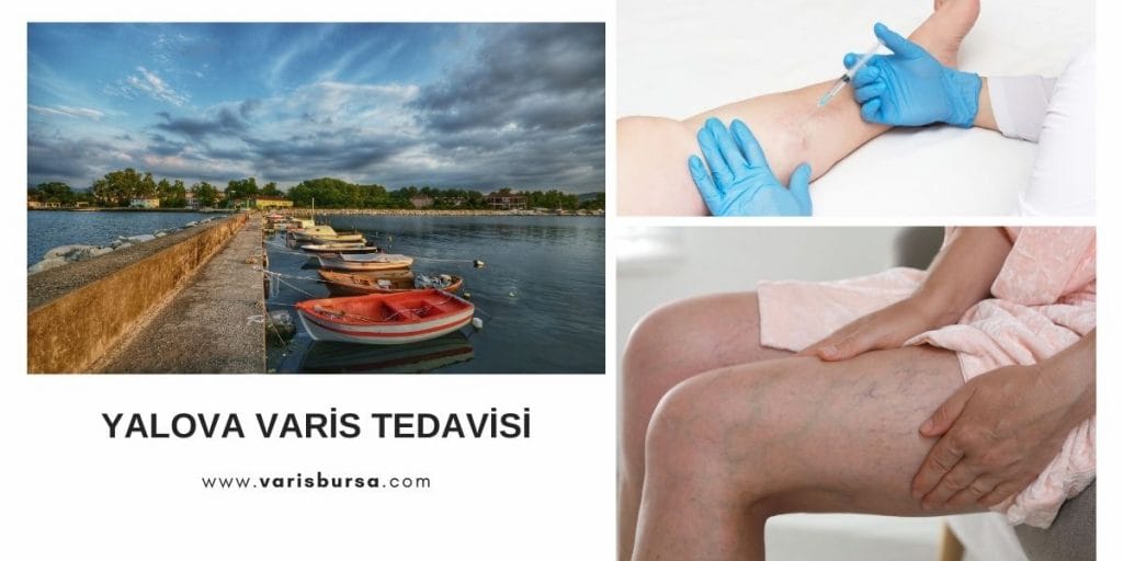 Yalova Varis Tedavisi