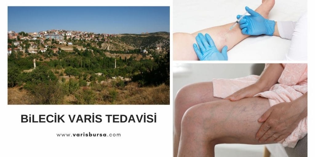 Bilecik Varis Tedavisi