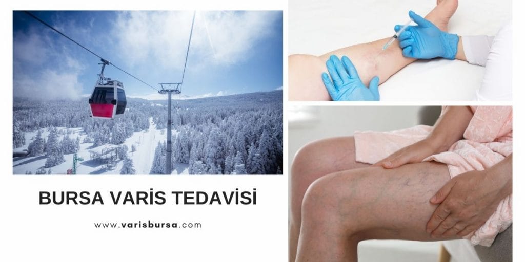 Bursa Varis Tedavisi