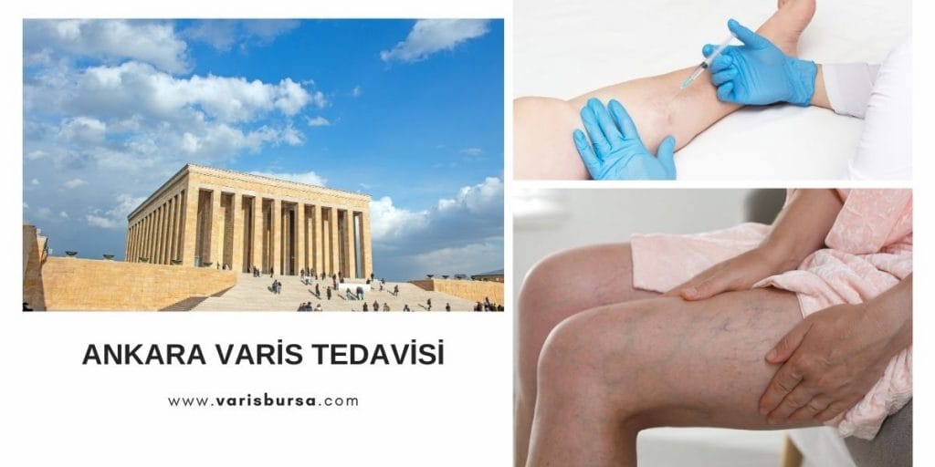 Ankara varis tedavi Ankara varis tedavi
