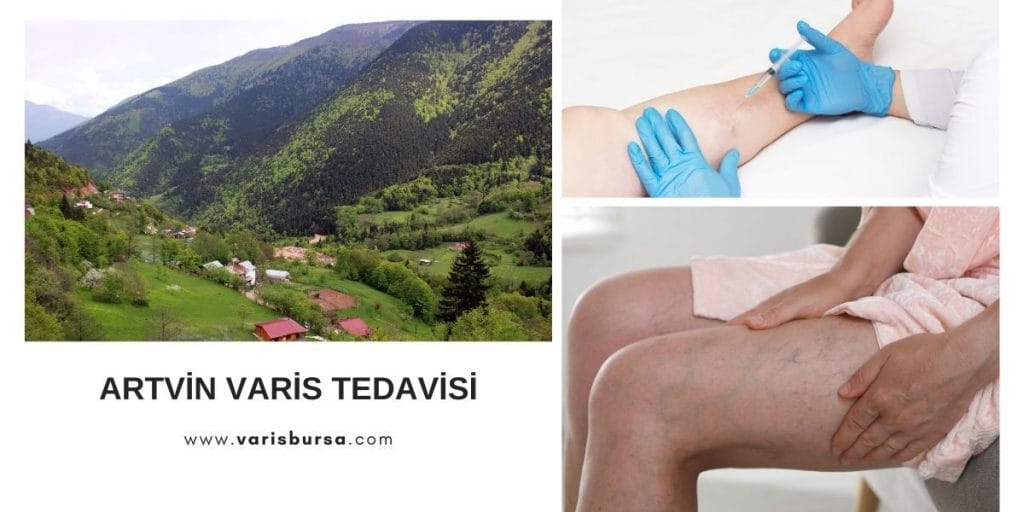 Artvin Varis Tedavisi