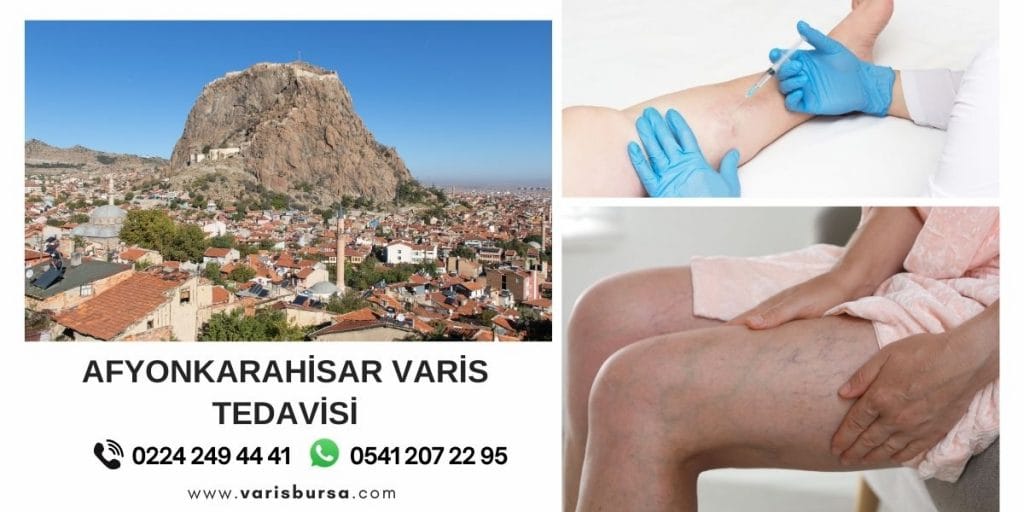 Afyonkarahisar Varis Tedavi