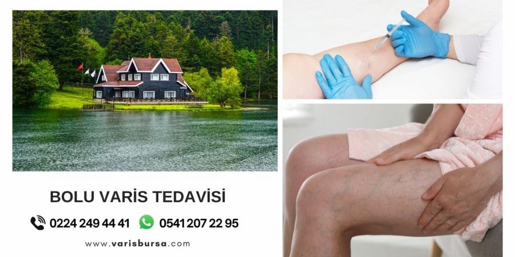 Bolu Varis Tedavisi