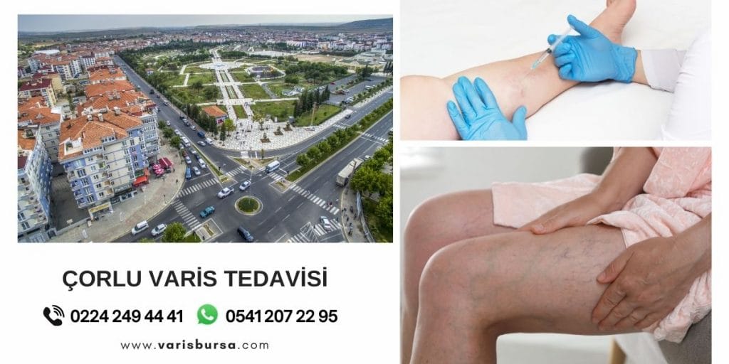 Çorlu Varis Tedavi