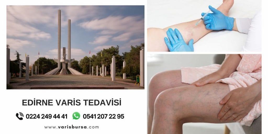 Edirne Varis Tedavisi