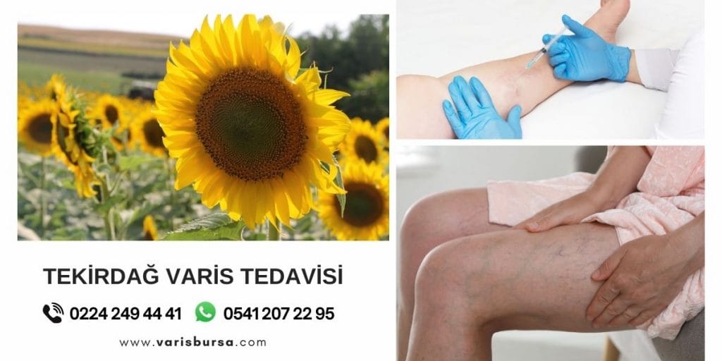 Tekirdağ Varis Tedavi