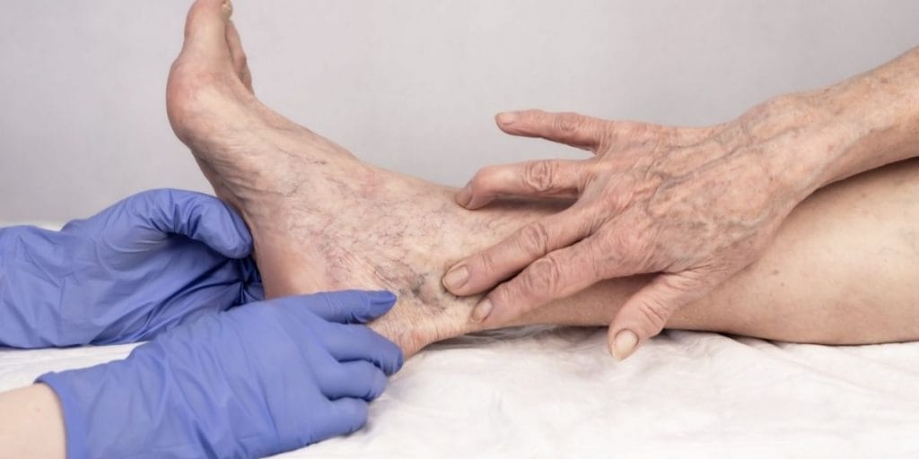 Venöz Yetmezlik Nedir