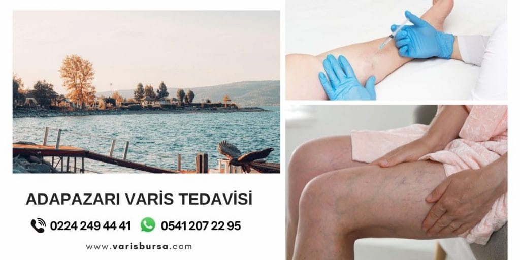 adapazarı varis tedavisi