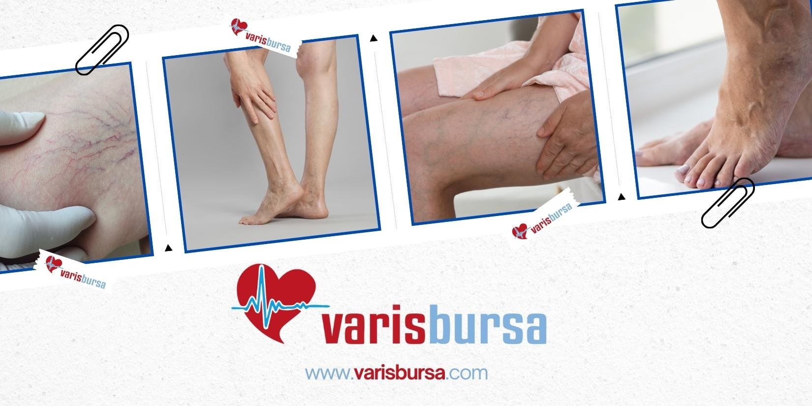 varisbursa ameliyatsız