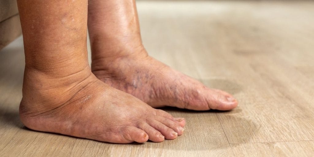 Bacaklarınızdaki Şişliğin Nedeni Varis Olabilir